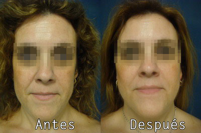 Cirugia Facial Lipofilling en Clinica BMS