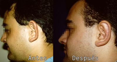 Cirugia Facial Orejas en Clinica BMS
