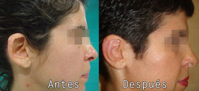 Cirugia Facial Orejas en Clinica BMS