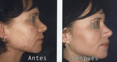 Cirugia Estetica Facial Manchas Faciales en Clinica BMS