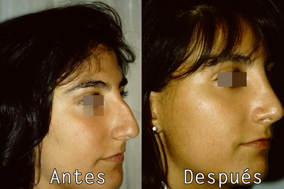 Cirugia Estética nariz en Clinica BMS